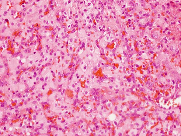 9B3 Hemangioblastoma, VHL (Case 9) H&E 3