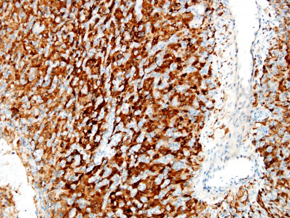 9C2 Hemangioblastoma, VHL (Case 9) Inhibin 2