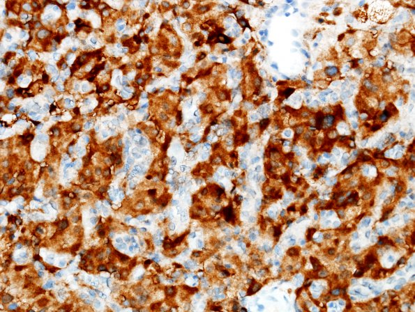 9C3 Hemangioblastoma, VHL (Case 9) Inhibin 1