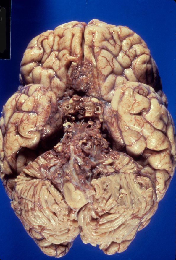 10A1 Hemangioblastoma (Case 10)