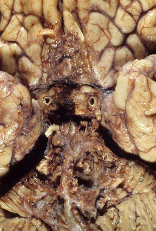 10A2 Hemangioblastoma (Case 10) 2