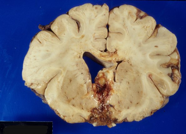 10A3 Hemangioblastoma (Case 10) 3