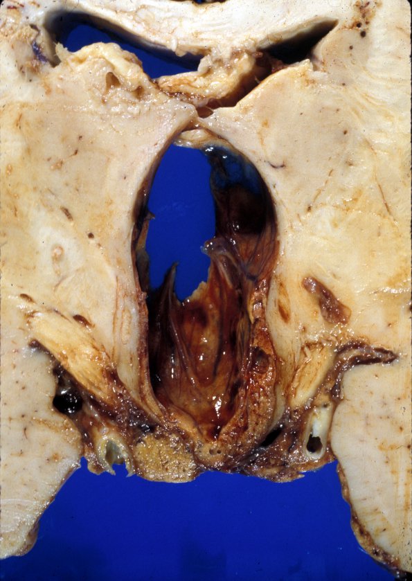 10A4 Hemangioblastoma (Case 10) 6