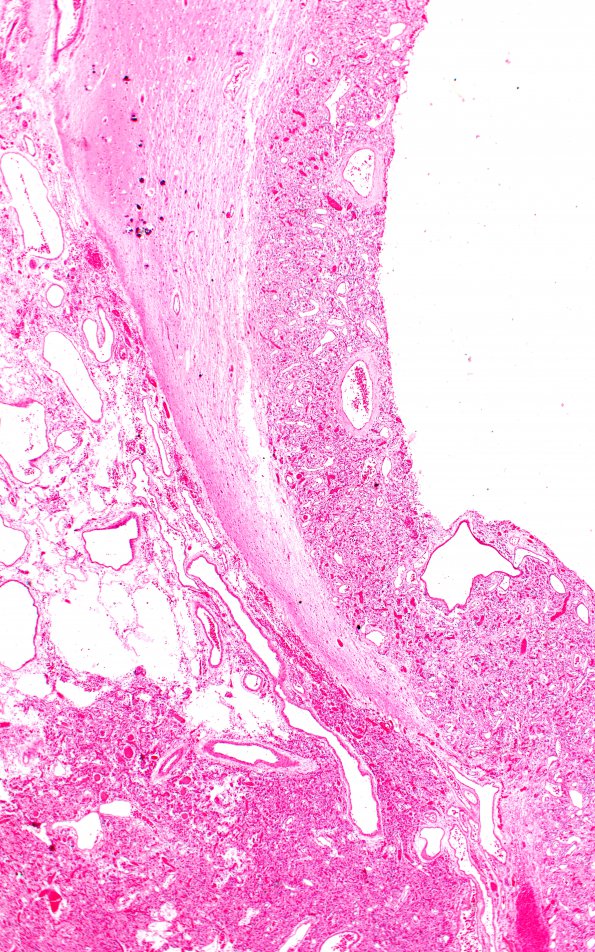 10A6 (Case 10) H&E f 2X