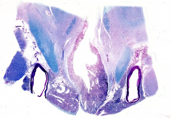 10A9 Hemangioblastoma (Case 10) 8