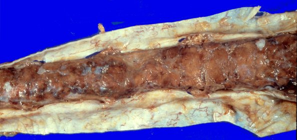 10B1 Hemangioblastoma (Case 10) 1