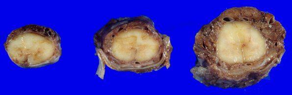 10B2 Hemangioblastoma (Case 10) 4