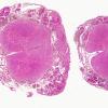 10B3 Hemangioblastoma  (Case 10) Retic WM