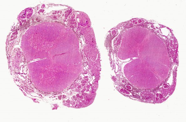 10B3 Hemangioblastoma  (Case 10) Retic WM