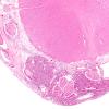 10B4 Hemangioblastoma  (Case 10) H&E Ventral root 2X