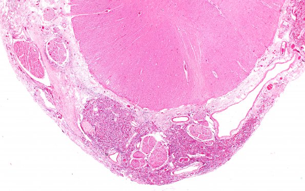 10B4 Hemangioblastoma  (Case 10) H&E Ventral root 2X