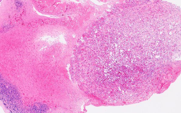 11A1 Hemangioblastoma (Case 11) H&E 4X 2