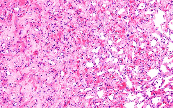 11A2 Hemangioblastoma (Case 11) H&E 20X