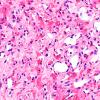 11A3 Hemangioblastoma (Case 11) H&E 40X