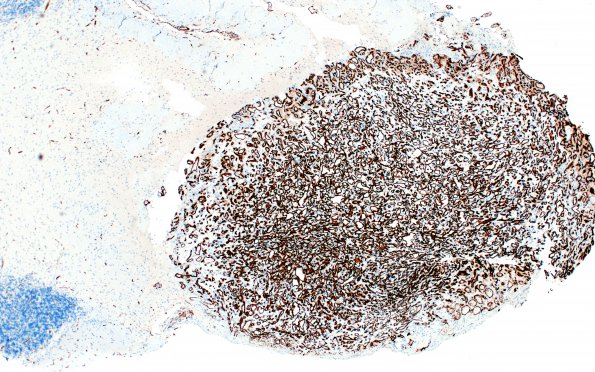 11B1 Hemangioblastoma (Case 11) CD34 4X