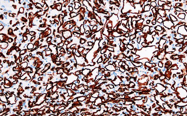11B2 Hemangioblastoma (Case 11) CD34 20X