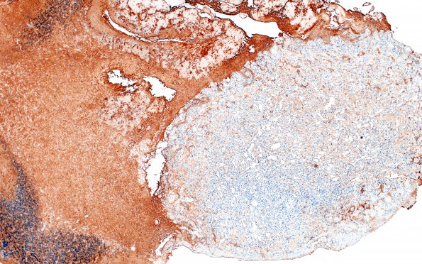 11C1 Hemangioblastoma (Case 11) S100 4X