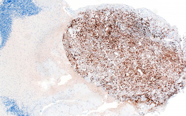 11D1 Hemangioblastoma (Case 11) Inhibin 4X