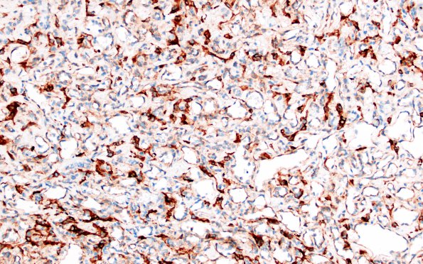 11D2 Hemangioblastoma (Case 11) Inhibin 20X