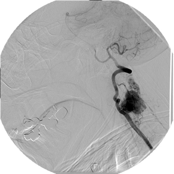 12A1 Hemangioblastoma, Cx lepto (Case 12) Angiogram 1 - Copy