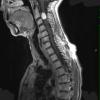 12A2 Hemangioblastoma, Cx lepto (Case 12) T1 W 2 - Copy