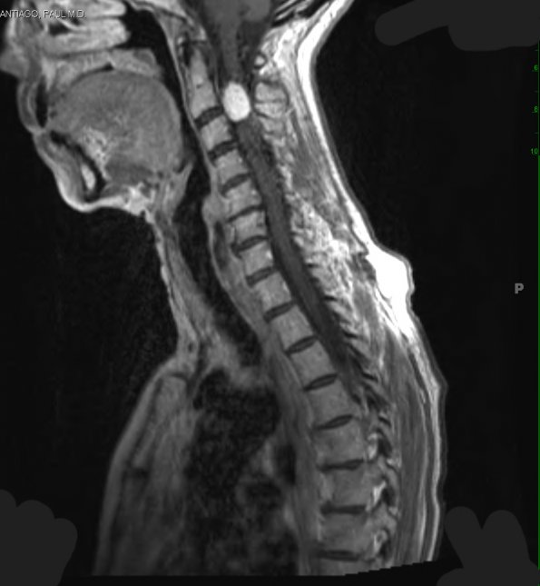 12A2 Hemangioblastoma, Cx lepto (Case 12) T1 W 2 - Copy