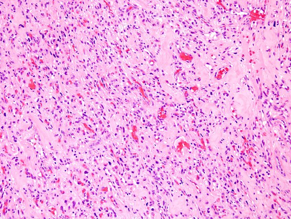 12B1 Hemangioblastoma, Cx lepto (Case 12) H&E 2