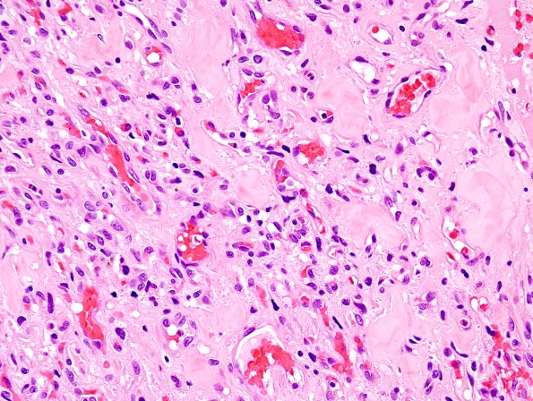 12B2 Hemangioblastoma, Cx lepto (Case 12) H&E 1