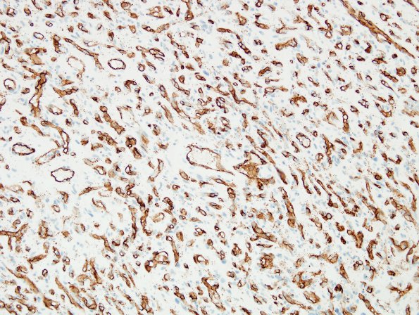 12C Hemangioblastoma, Cx lepto (Case 12) CD34