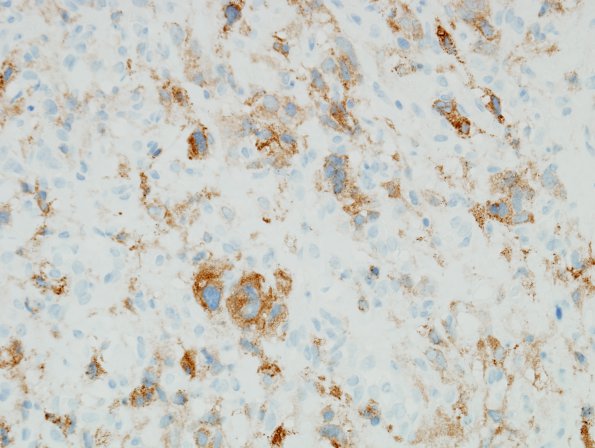 12E Hemangioblastoma, Cx lepto (Case 12) Inhibin 1