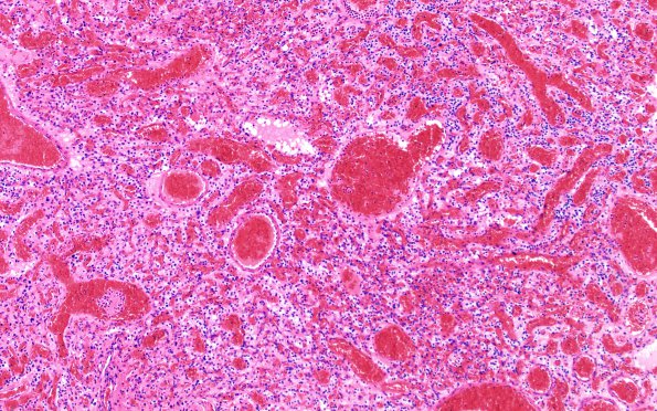 13A1 Hemangioblastoma (Case 13) H&E 2