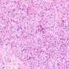 13A2 Hemangioblastoma (Case 13) H&E 20X