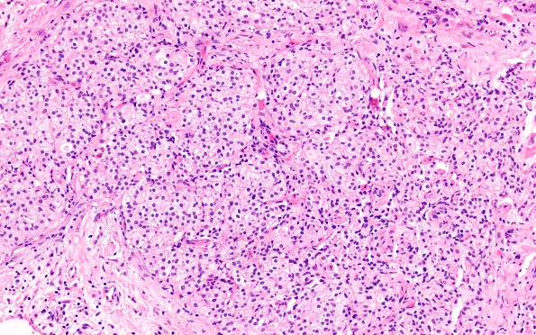 13A2 Hemangioblastoma (Case 13) H&E 20X