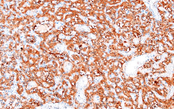 13B1 Hemangioblastoma (Case 13) S100 2