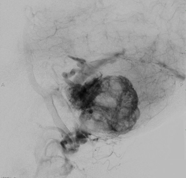 14A1 Hemangioblastoma (Case 14) MRI Angiogram 2