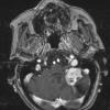 14A2 Hemangioblastoma (Case 14) T1 question contrast - Copy