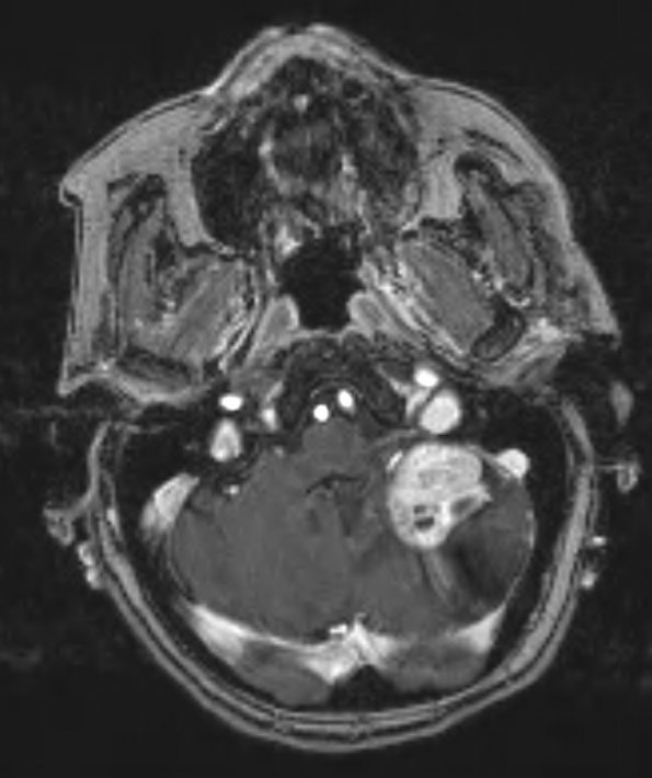 14A2 Hemangioblastoma (Case 14) T1 question contrast - Copy