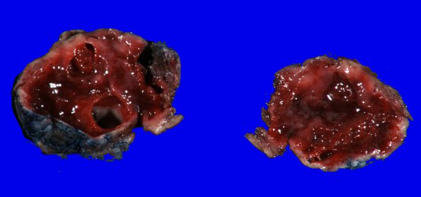 14B Hemangioblastoma (Case 14)-gross-3