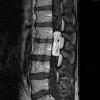 15A Hemangioblastoma (Case 15) T1 W 3 - Copy