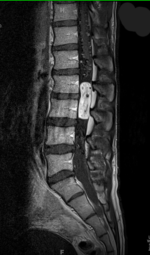 15A Hemangioblastoma (Case 15) T1 W 3 - Copy