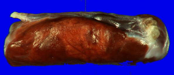 15B1 Hemangioblastoma, spinal cord (Case 15) Gross _1