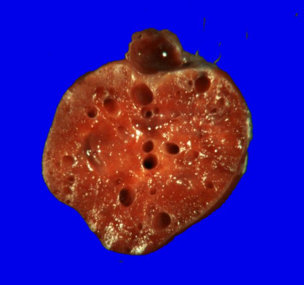 15B2 Hemangioblastoma, spinal cord (Case 15) Gross _3