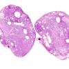 15C1 Hemangioblastoma (Case 15) H&E WM