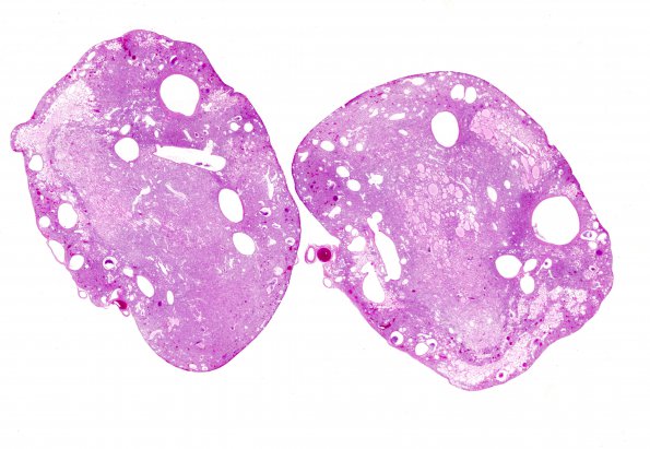 15C1 Hemangioblastoma (Case 15) H&E WM