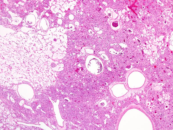 15C2 Hemangioblastoma (Case 15) H&E 1.jpg