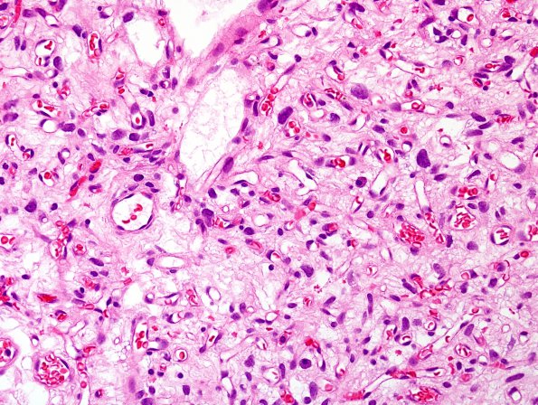 15C3 Hemangioblastoma (Case 15) H&E 6.jpg