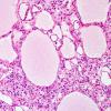  15C4 Hemangioblastoma (Case 15) H&E 9.jpg