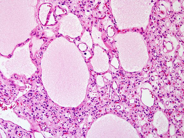  15C4 Hemangioblastoma (Case 15) H&E 9.jpg