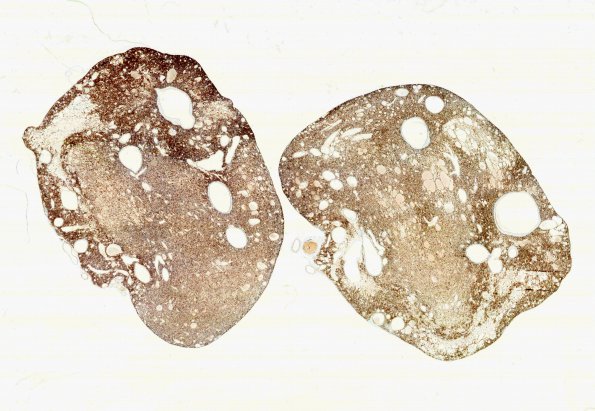 15D1 Hemangioblastoma (Case 15) CD34 whole mount