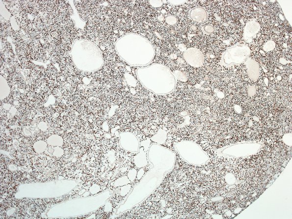 15D2 Hemangioblastoma (Case 15) CD34 4.jpg